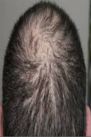 alopecia