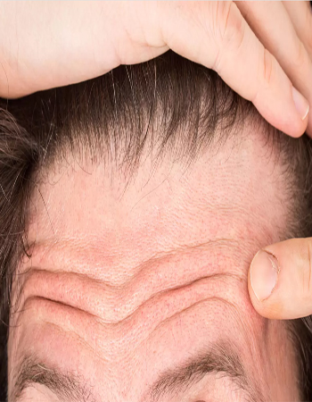 attaccatura capelli